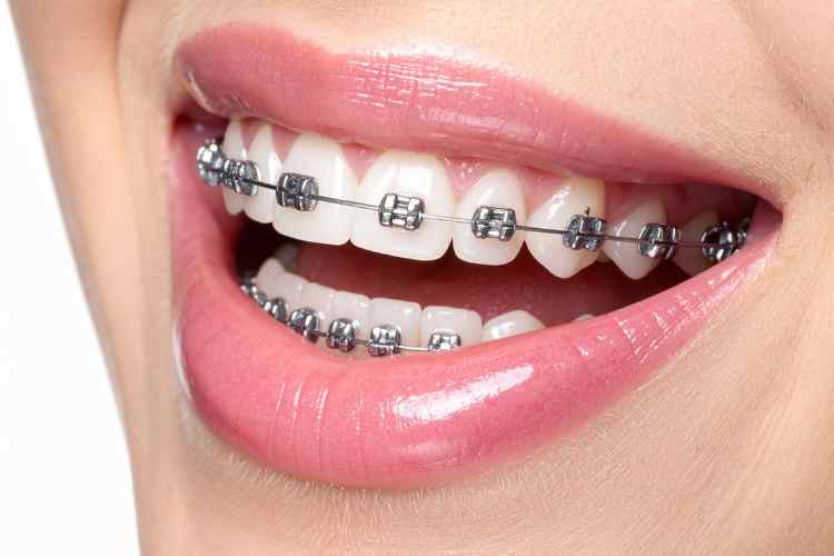 Self-Ligating Braces